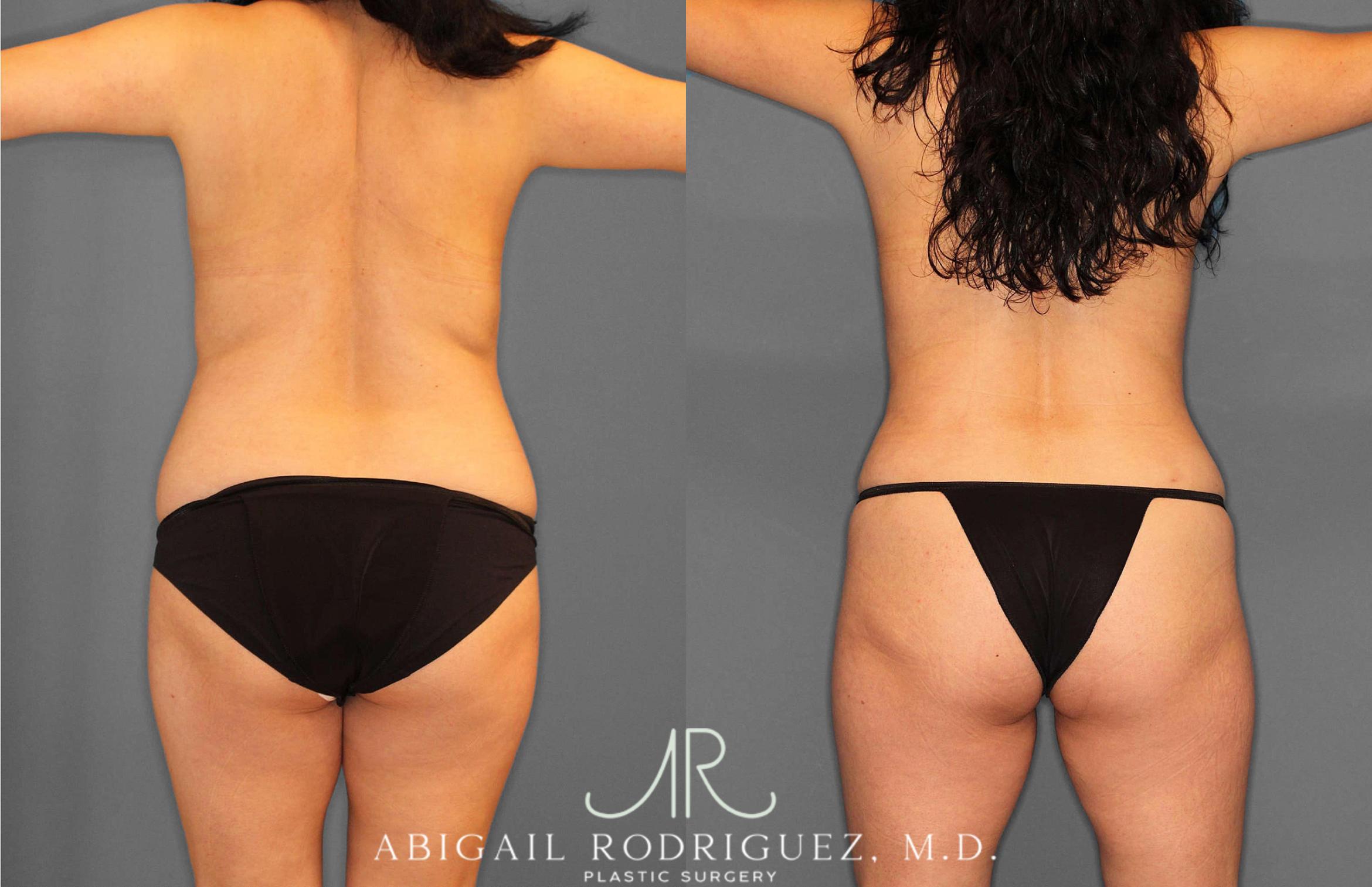 Before & After Liposuction Case 254862 View 5 View in Houston, TX