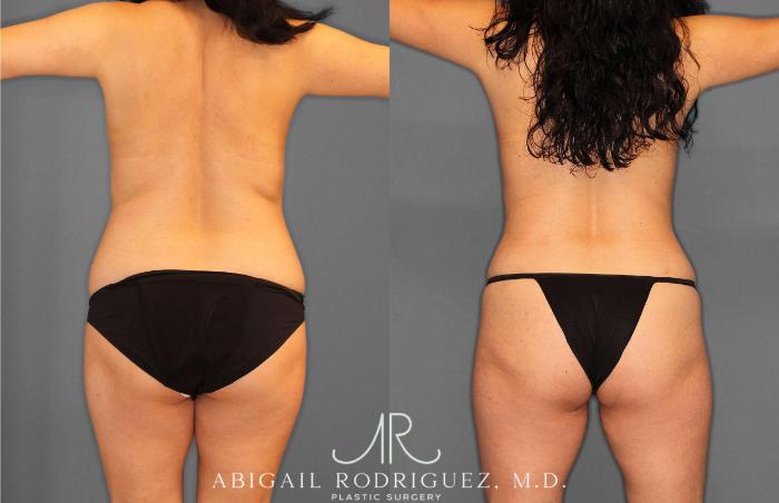 Before & After Liposuction Case 254862 View 5 View in Houston, TX