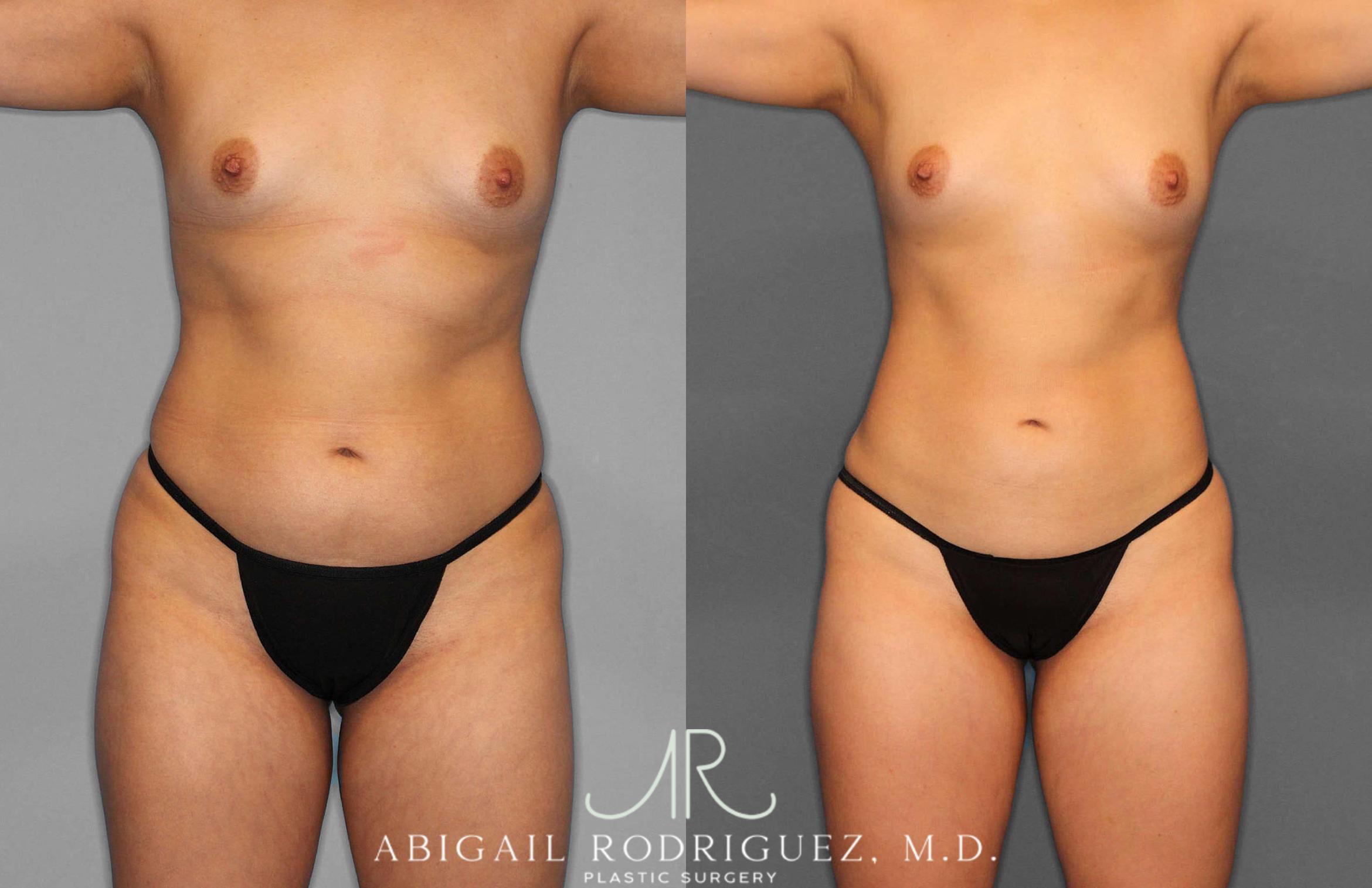 Before & After Liposuction Case 254931 View 1 View in Houston, TX