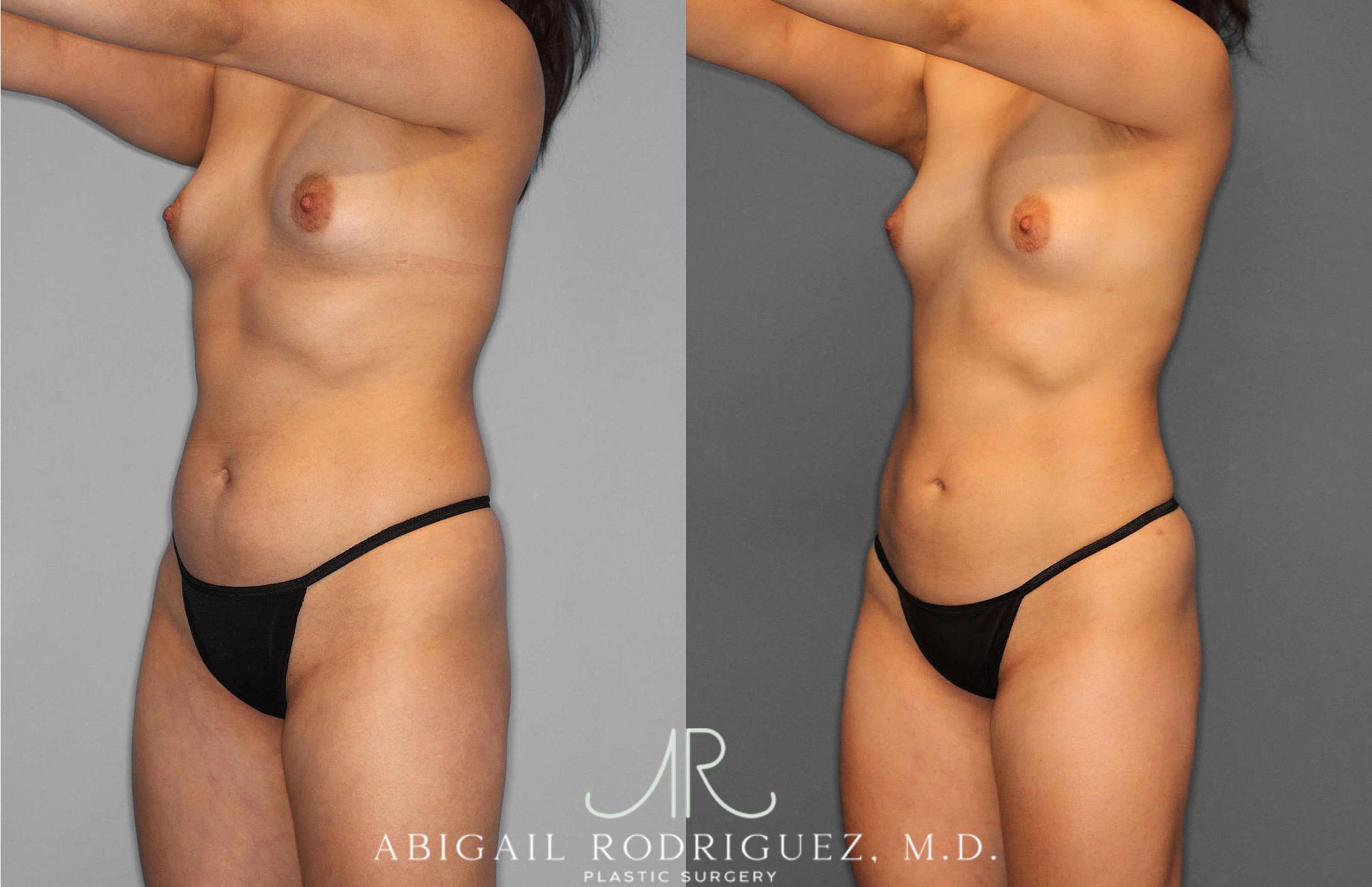 Before & After Liposuction Case 254931 View 2 View in Houston, TX