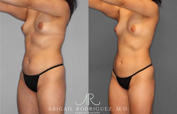 Before & After Liposuction Case 254931 View 2 View in Houston, TX