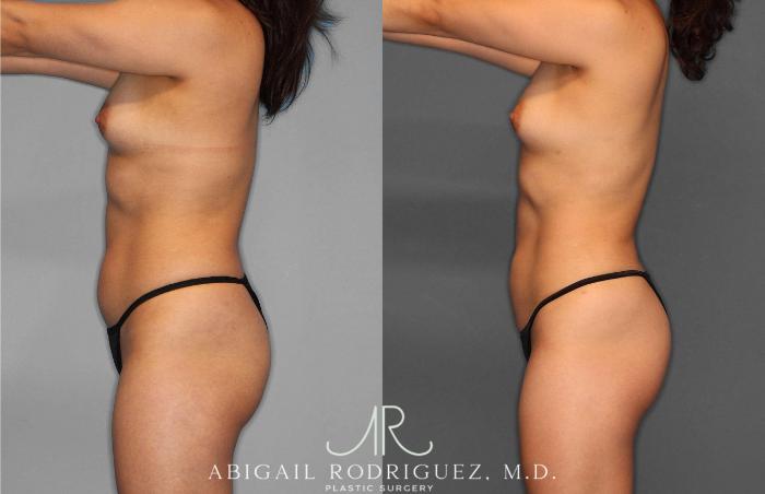 Before & After Liposuction Case 254931 View 3 View in Houston, TX