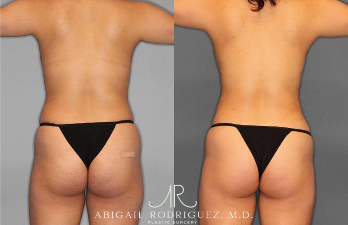 Before & After Liposuction Case 254931 View 4 View in Houston, TX