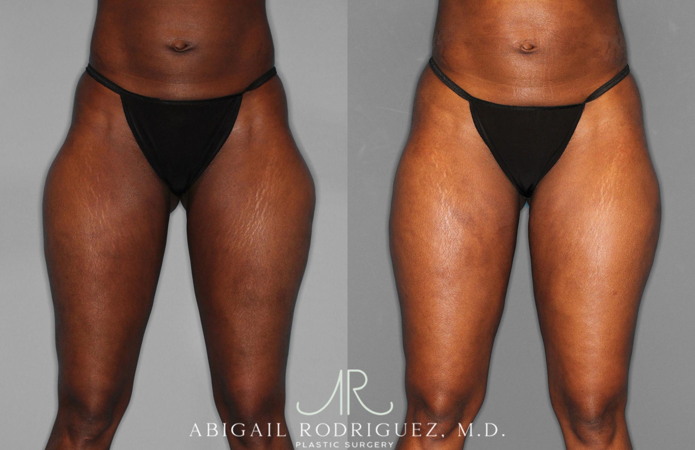 Before & After Liposuction Case 258593 View 1 View in Houston, TX