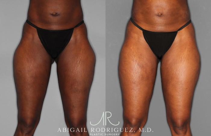 Before & After Liposuction Case 258593 View 1 View in Houston, TX