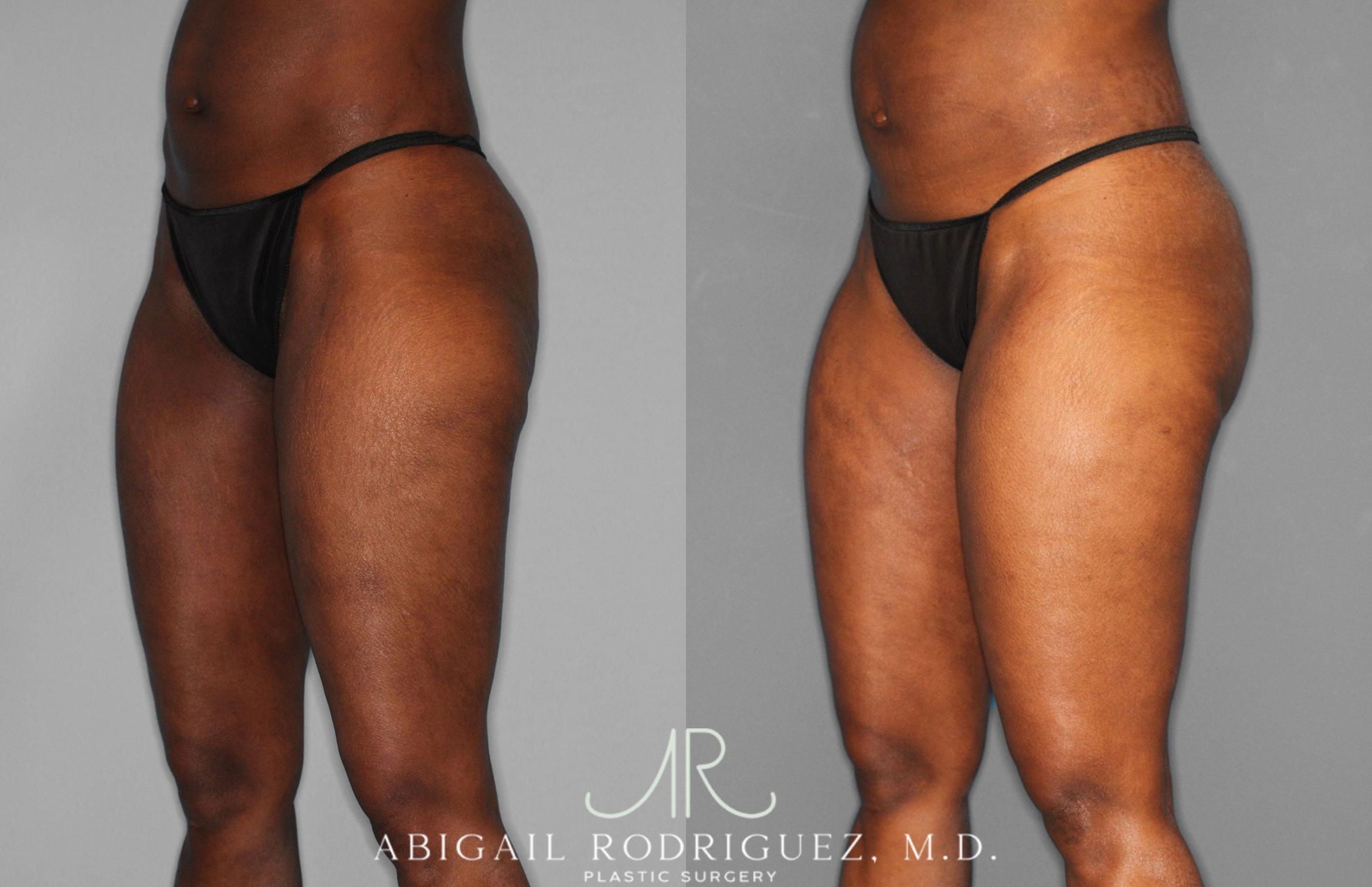 Before & After Liposuction Case 258593 View 2 View in Houston, TX