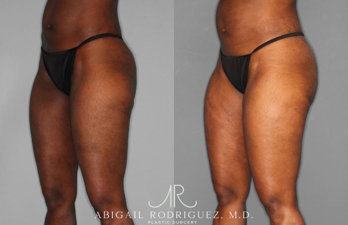 Before & After Liposuction Case 258593 View 2 View in Houston, TX