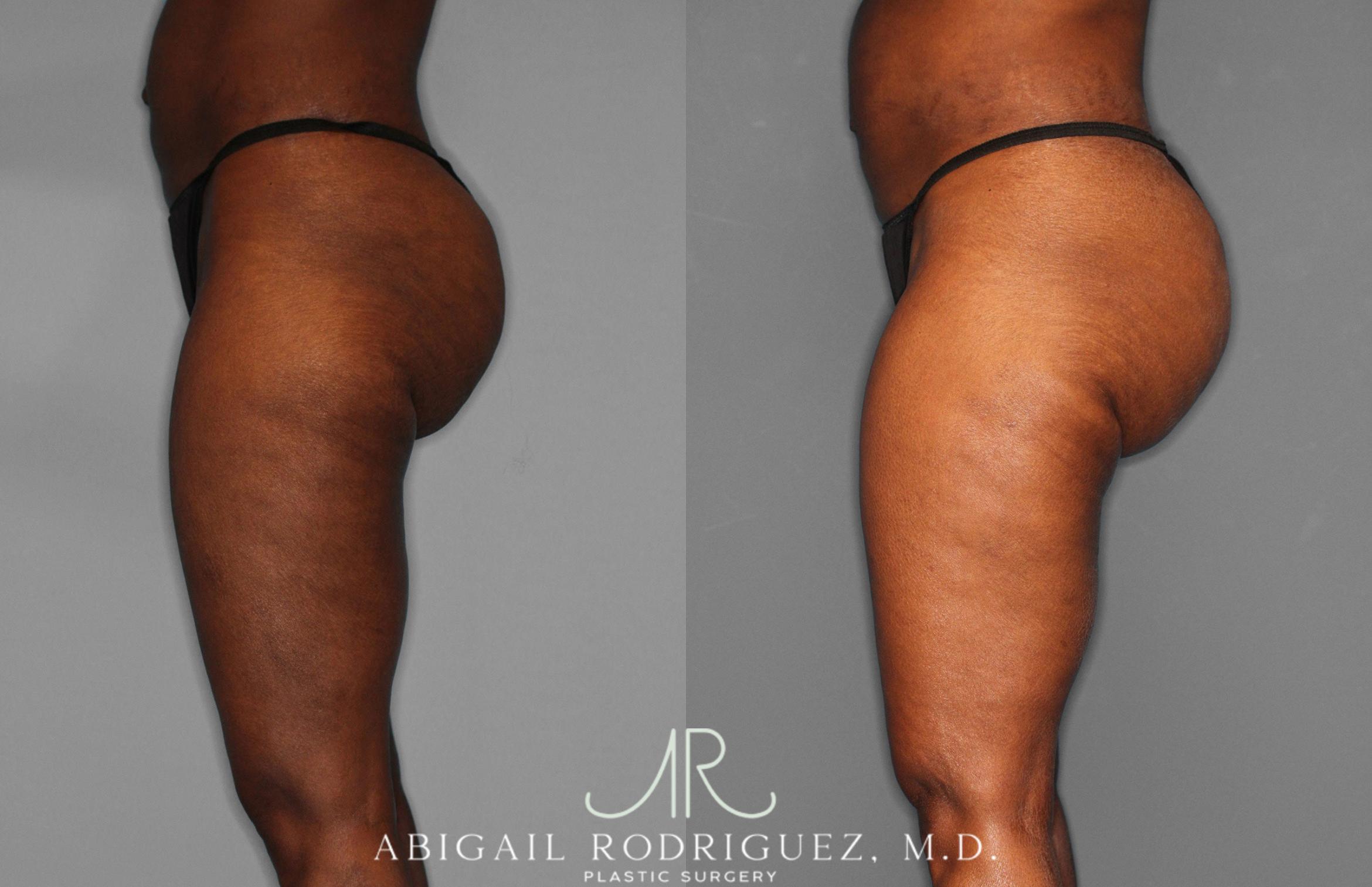 Before & After Liposuction Case 258593 View 3 View in Houston, TX