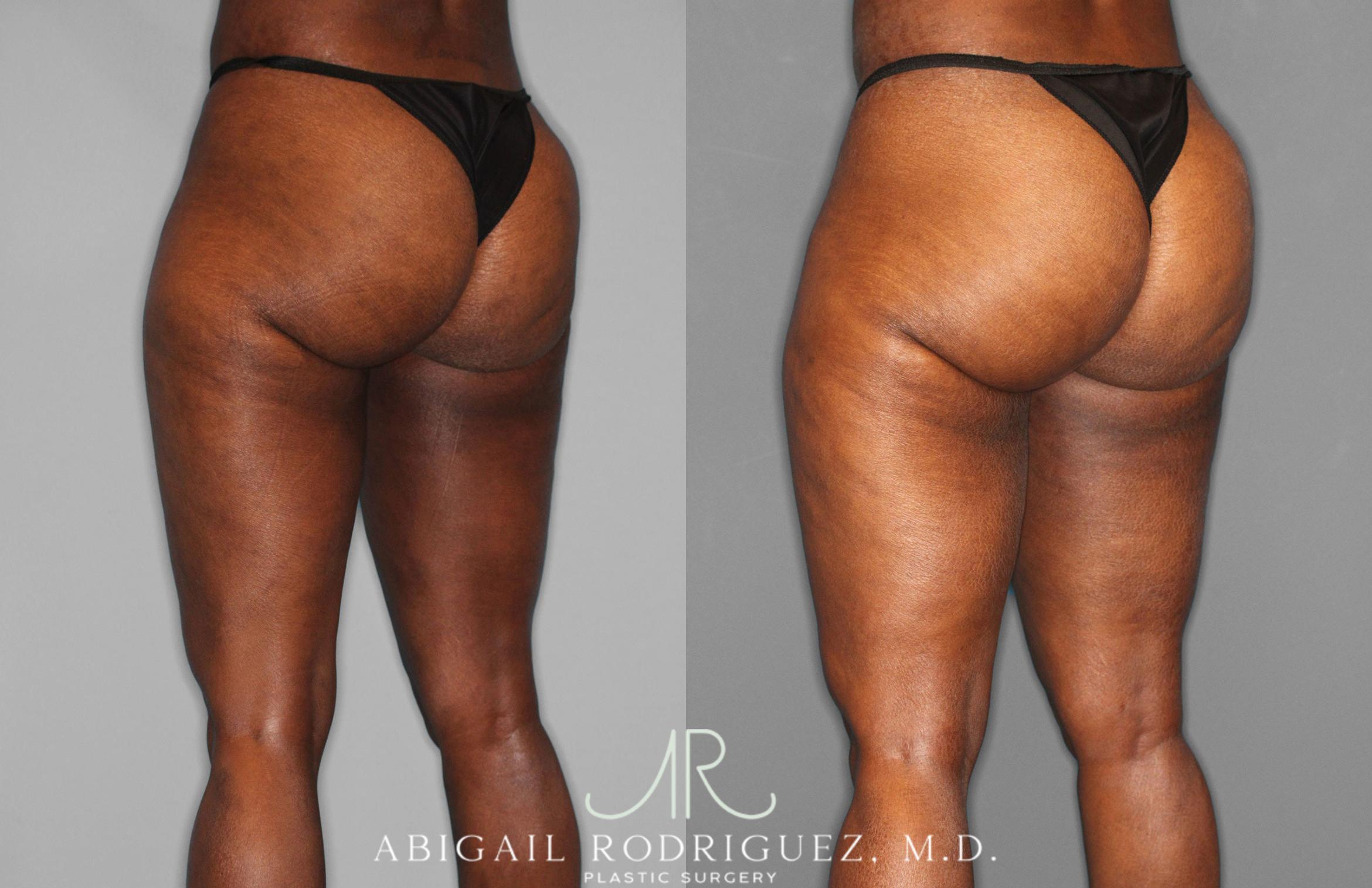 Before & After Liposuction Case 258593 View 4 View in Houston, TX