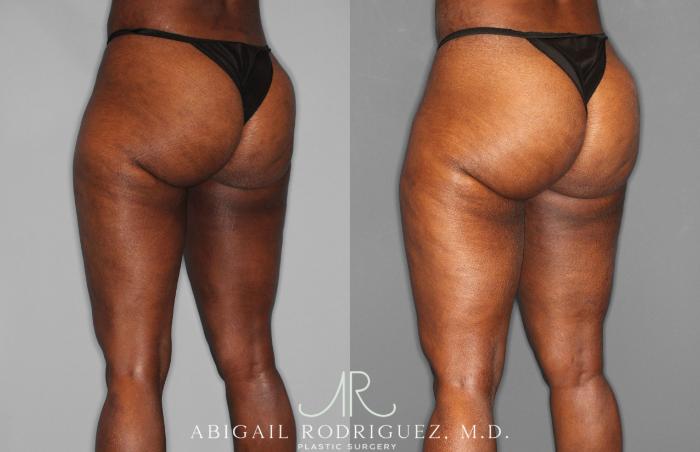 Before & After Liposuction Case 258593 View 4 View in Houston, TX