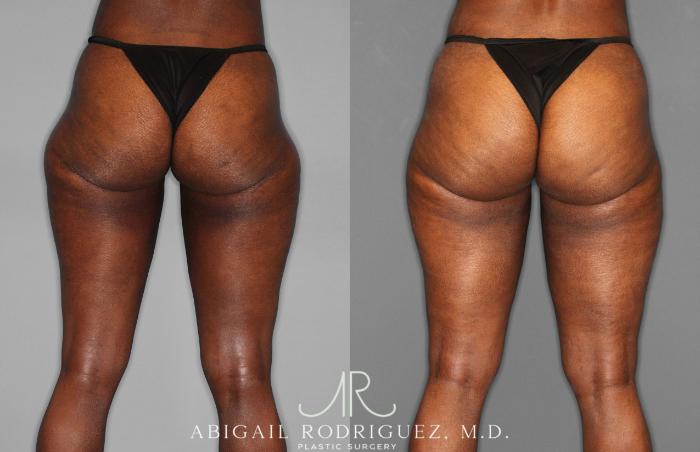 Before & After Liposuction Case 258593 View 5 View in Houston, TX