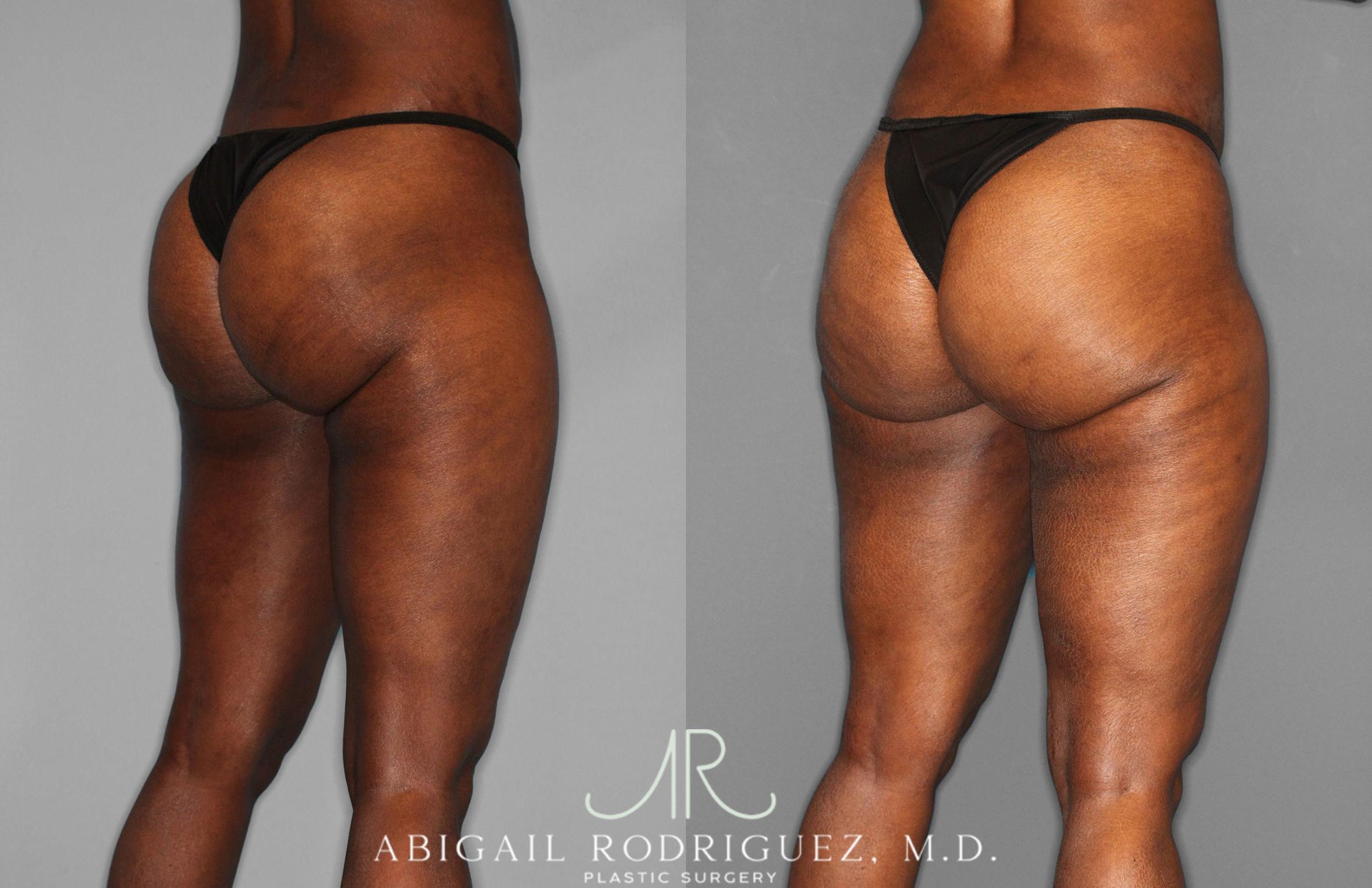 Before & After Liposuction Case 258593 View 6 View in Houston, TX