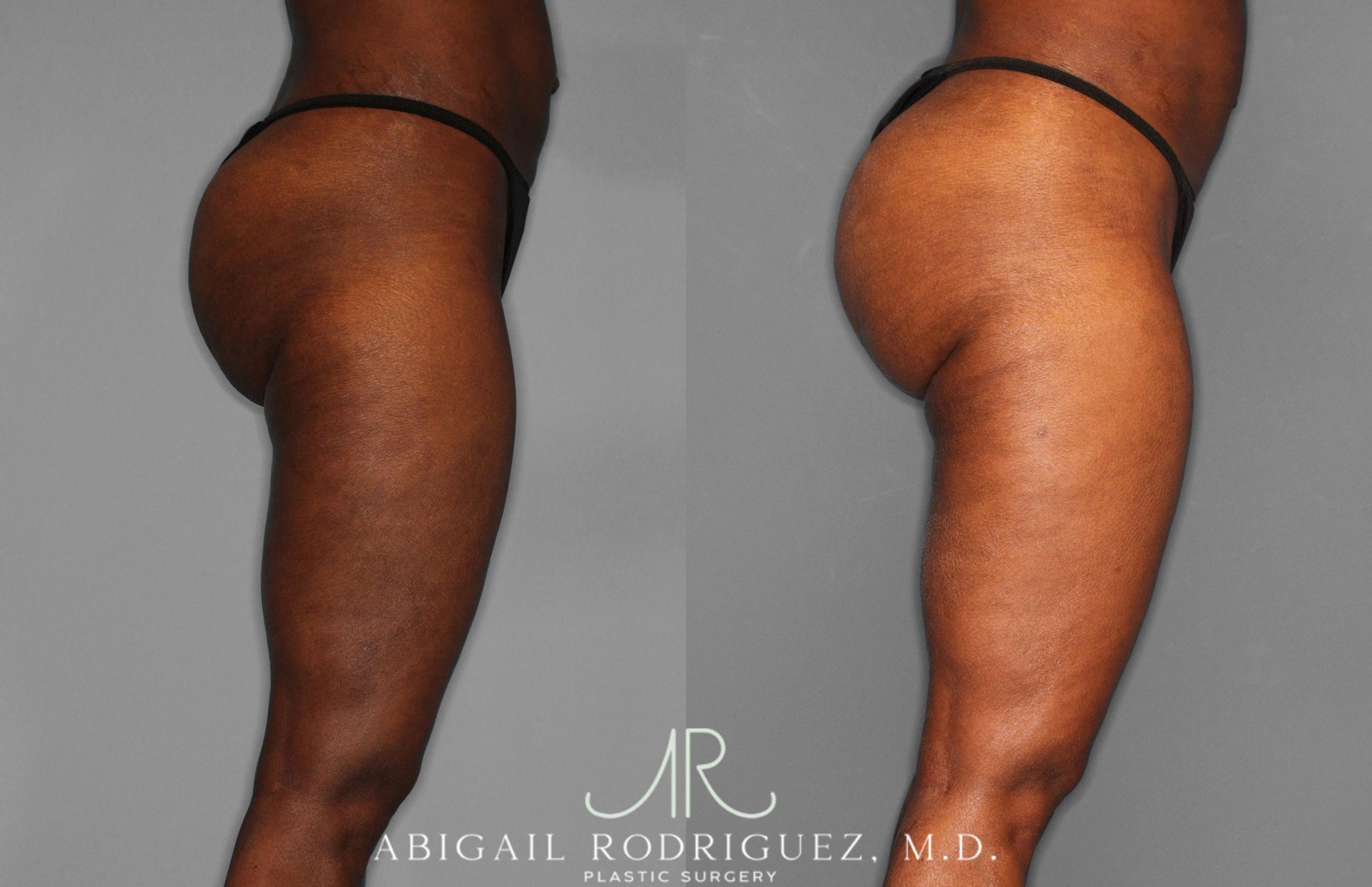 Before & After Liposuction Case 258593 View 7 View in Houston, TX