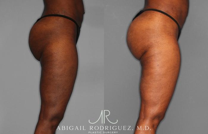 Before & After Liposuction Case 258593 View 7 View in Houston, TX