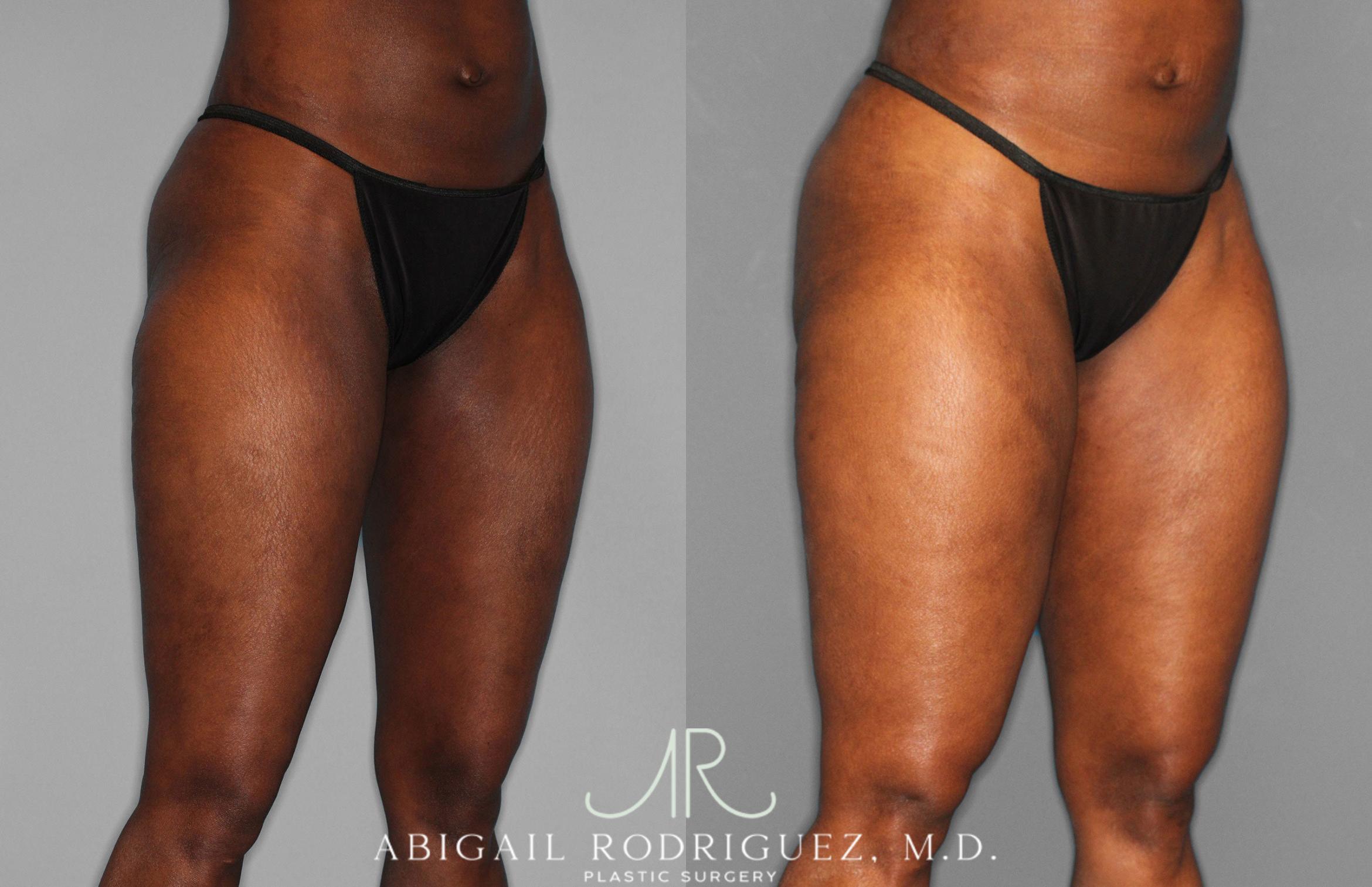 Before & After Liposuction Case 258593 View 8 View in Houston, TX