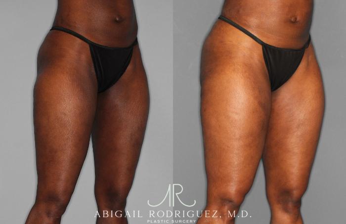 Before & After Liposuction Case 258593 View 8 View in Houston, TX