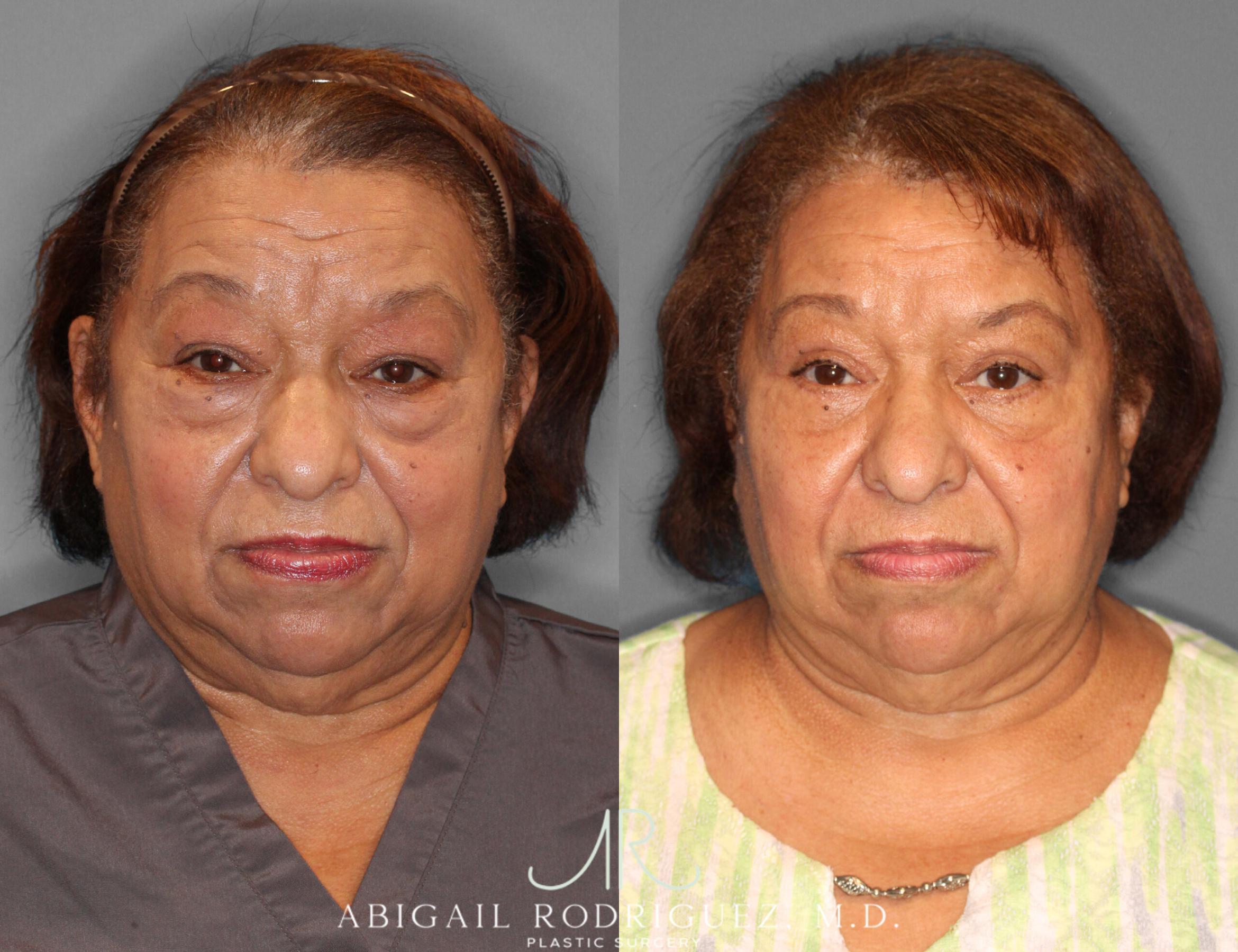 Before & After Lower Eyelid Lift Case 254043 View 1 View in Houston, TX