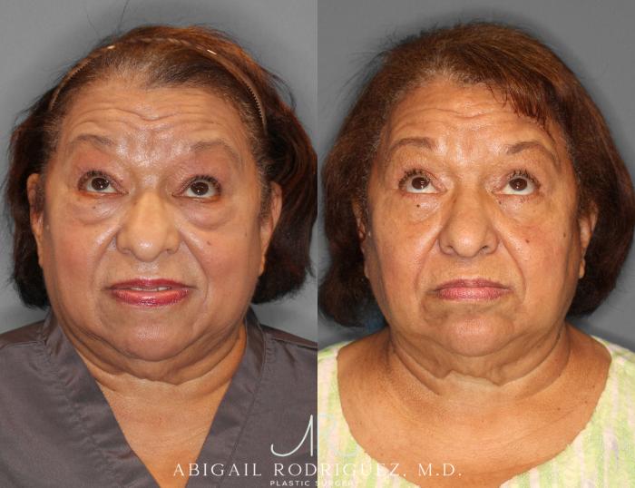 Before & After Lower Eyelid Lift Case 254043 View 2 View in Houston, TX