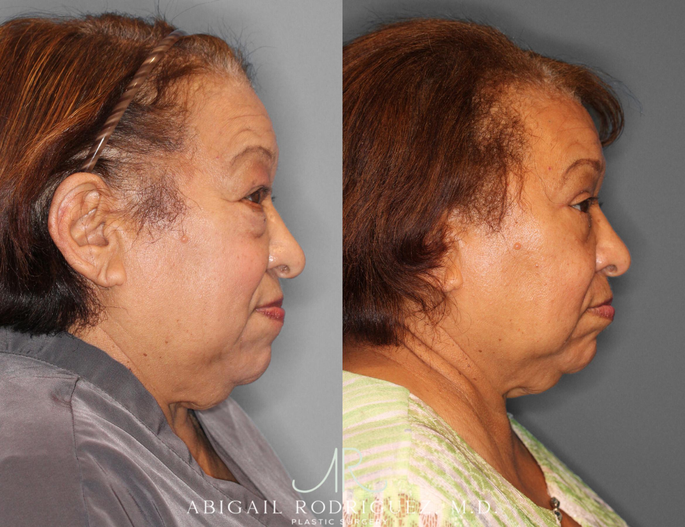 Before & After Lower Eyelid Lift Case 254043 View 3 View in Houston, TX