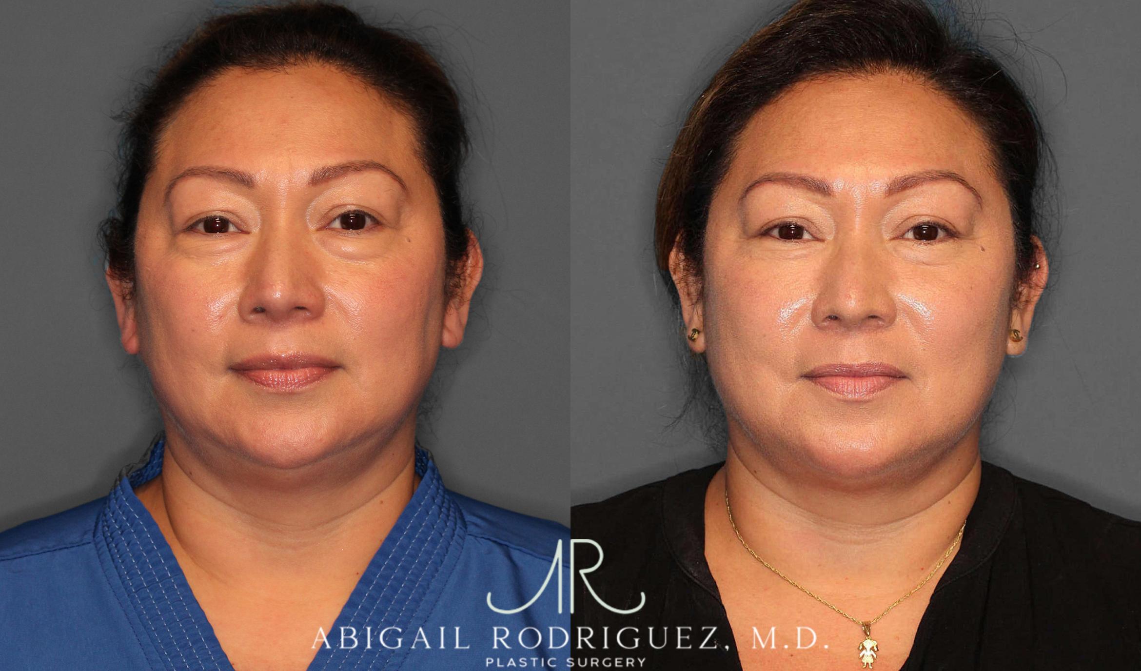 Before & After Lower Eyelid Lift Case 254339 View 1 View in Houston, TX