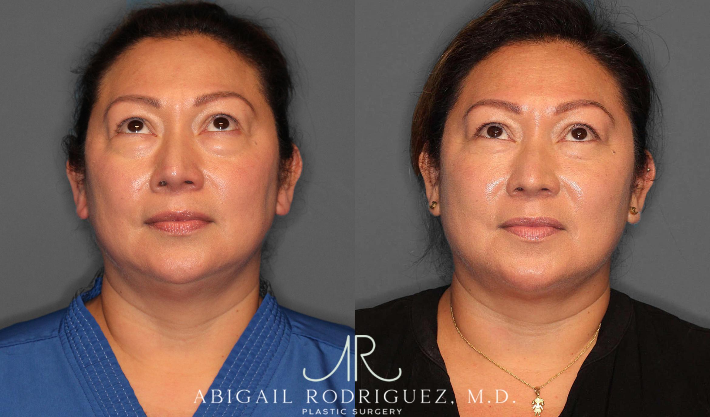 Before & After Lower Eyelid Lift Case 254339 View 2 View in Houston, TX