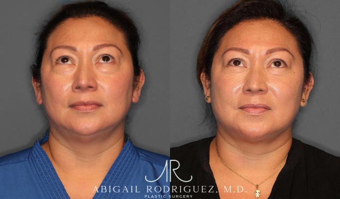 Before & After Lower Eyelid Lift Case 254339 View 2 View in Houston, TX