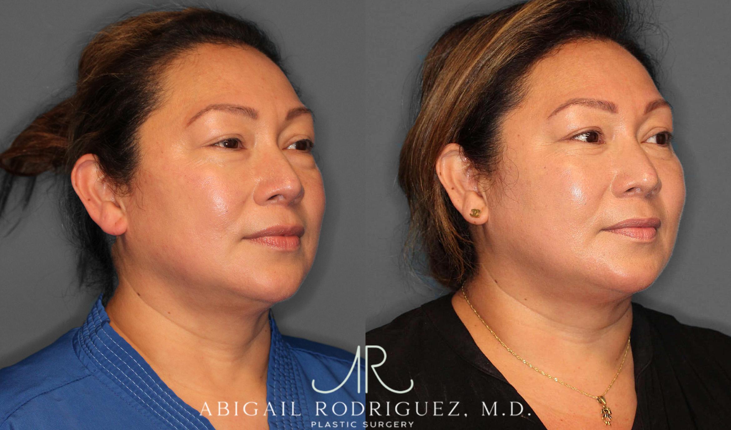 Before & After Lower Eyelid Lift Case 254339 View 3 View in Houston, TX
