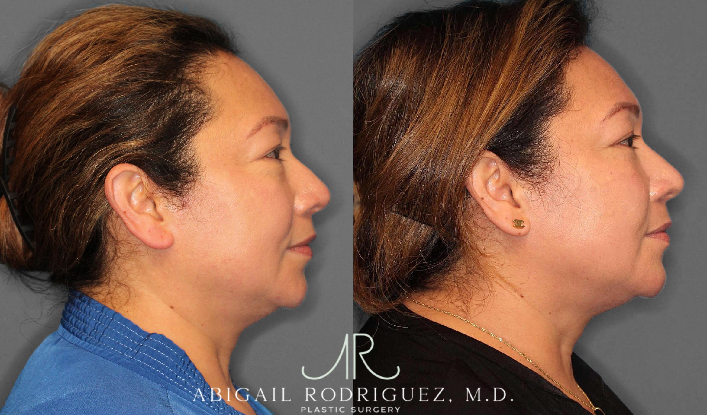 Before & After Lower Eyelid Lift Case 254339 View 4 View in Houston, TX