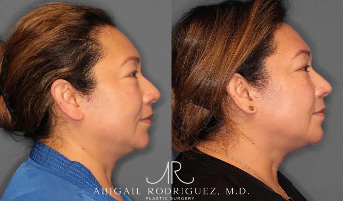 Before & After Lower Eyelid Lift Case 254339 View 4 View in Houston, TX