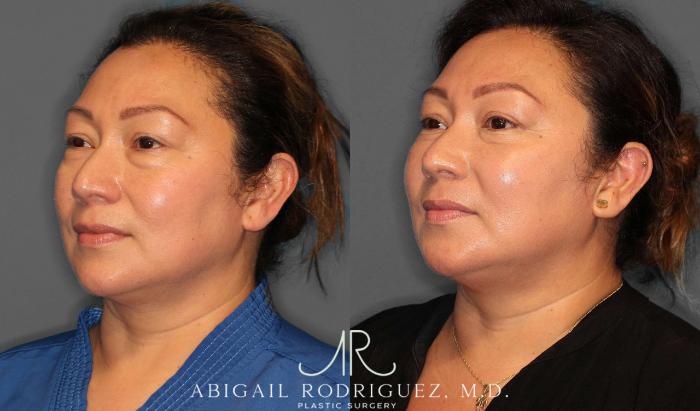 Before & After Lower Eyelid Lift Case 254339 View 5 View in Houston, TX