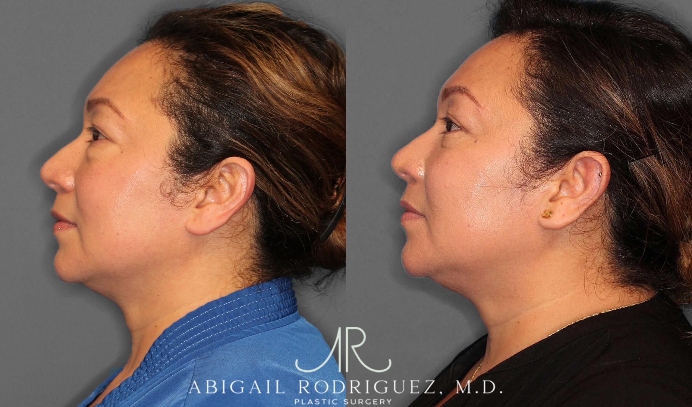 Before & After Lower Eyelid Lift Case 254339 View 6 View in Houston, TX