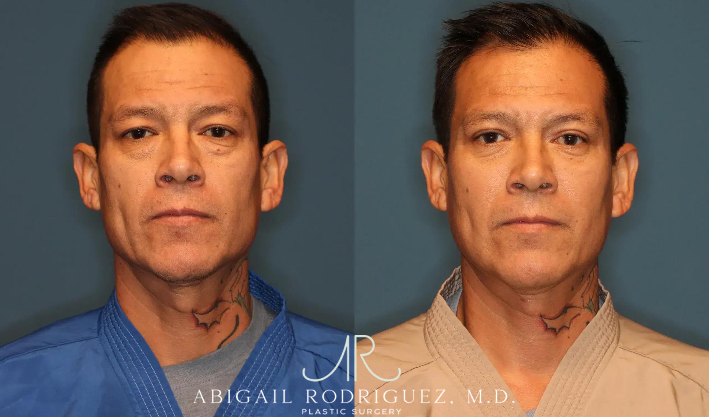 Before & After Lower Eyelid Lift Case 258370 View 1 View in Houston, TX