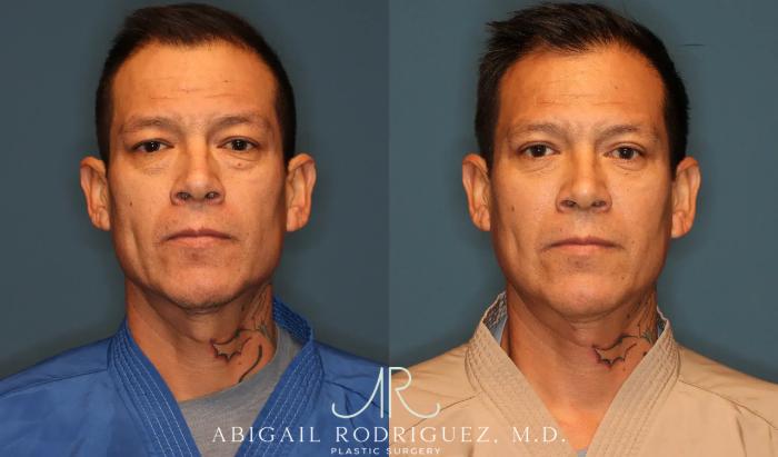 Before & After Lower Eyelid Lift Case 258370 View 1 View in Houston, TX