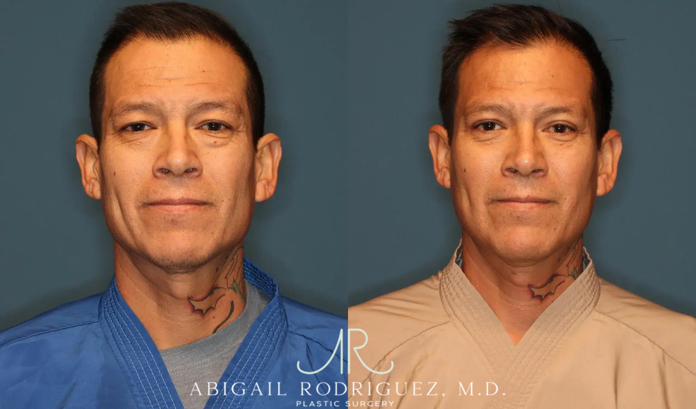 Before & After Lower Eyelid Lift Case 258370 View 2 View in Houston, TX