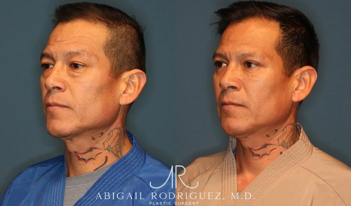 Before & After Lower Eyelid Lift Case 258370 View 3 View in Houston, TX