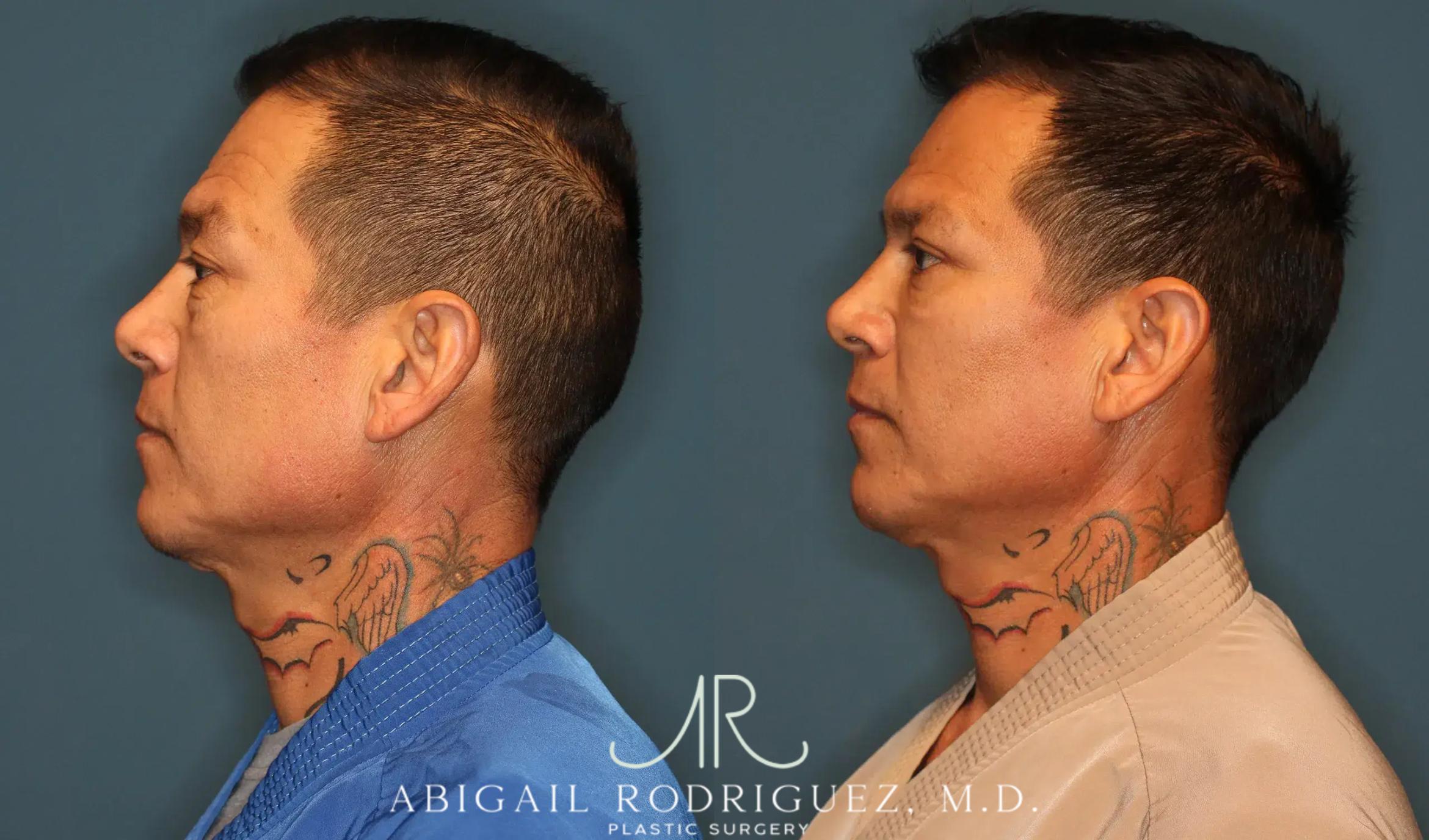 Before & After Lower Eyelid Lift Case 258370 View 4 View in Houston, TX