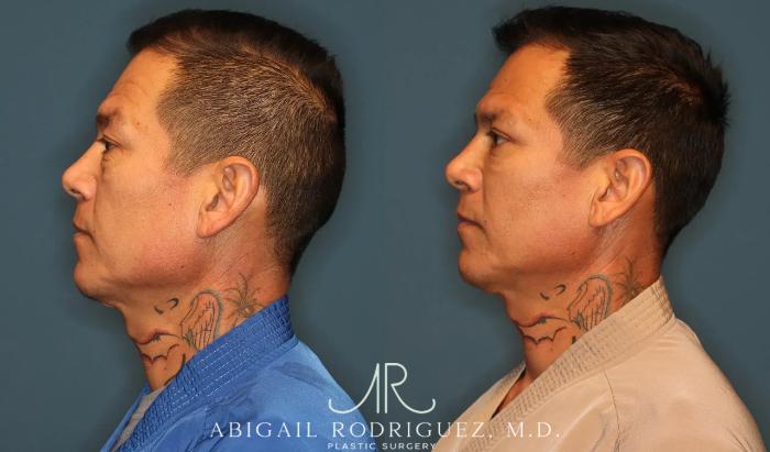 Before & After Lower Eyelid Lift Case 258370 View 4 View in Houston, TX