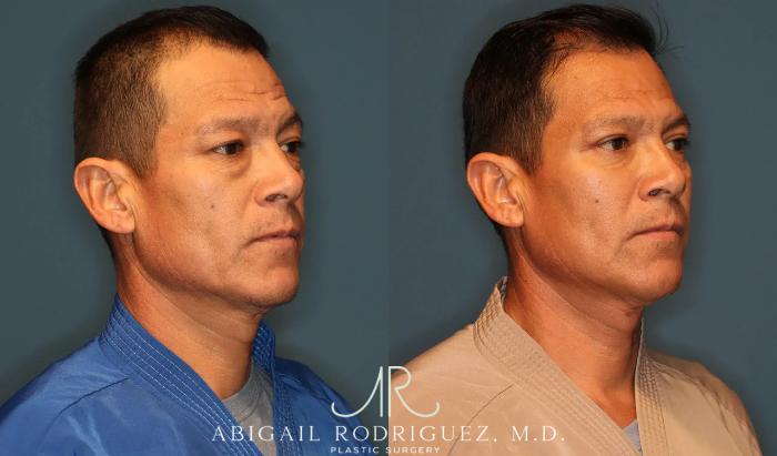 Before & After Lower Eyelid Lift Case 258370 View 5 View in Houston, TX