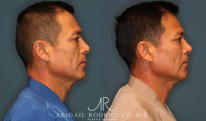 Before & After Lower Eyelid Lift Case 258370 View 6 View in Houston, TX