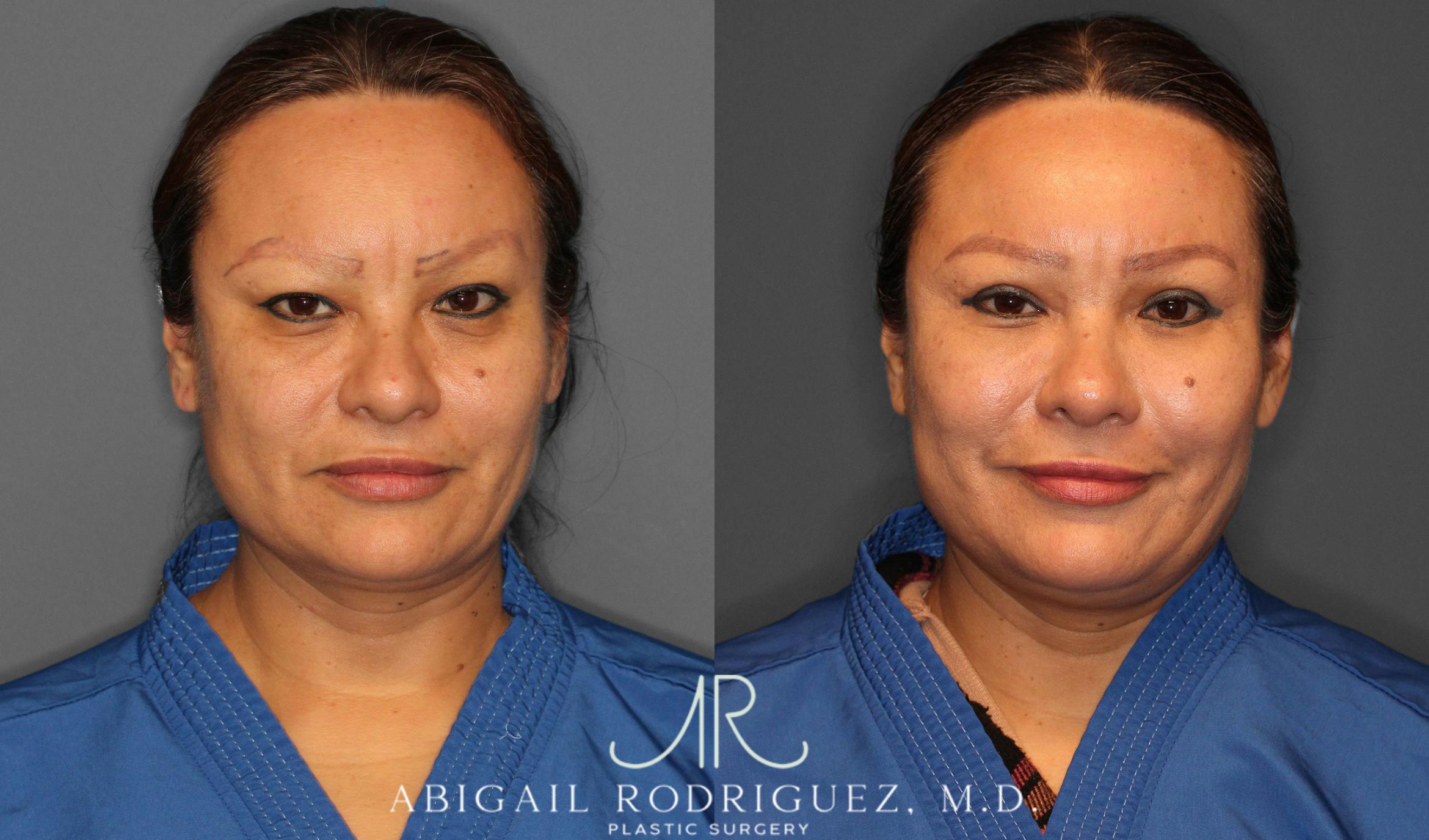 Before & After Lower Eyelid Lift Case 258632 View 1 View in Houston, TX