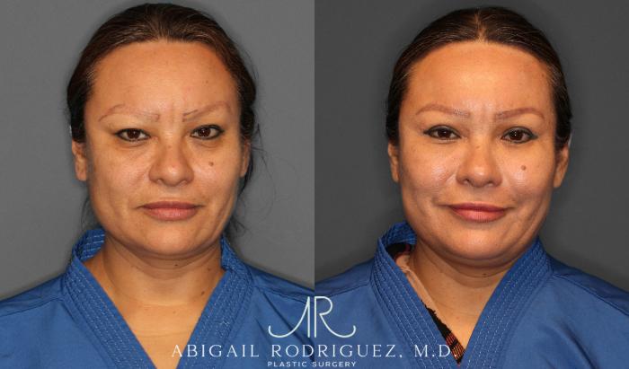 Before & After Lower Eyelid Lift Case 258632 View 1 View in Houston, TX