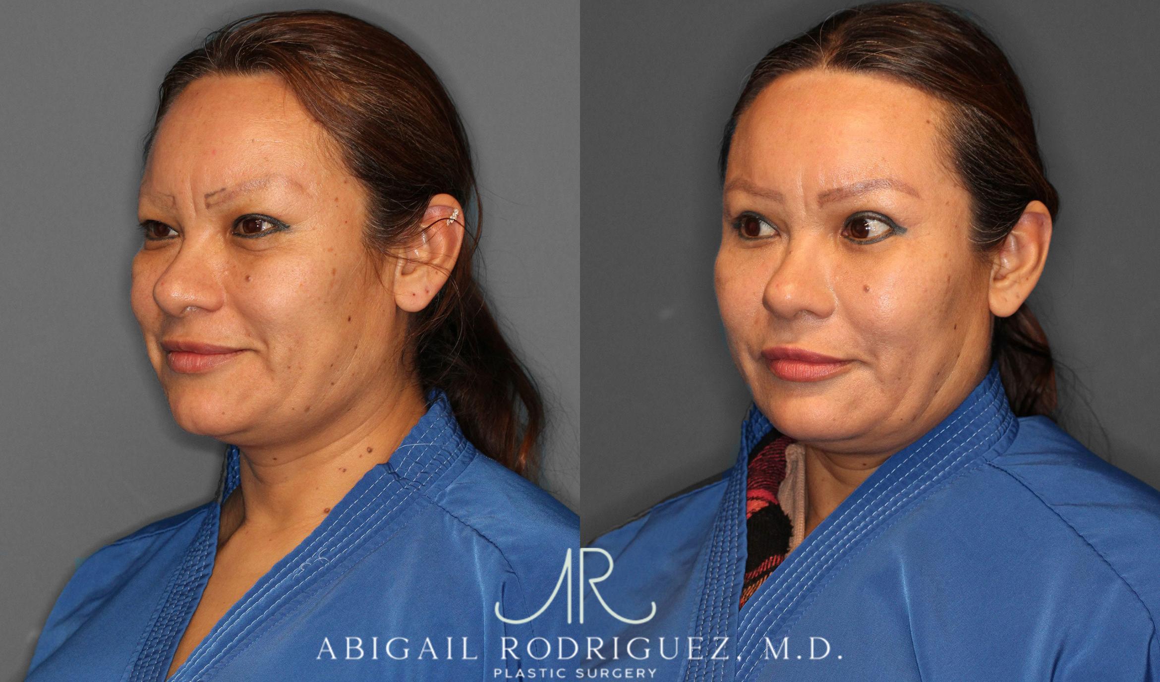 Before & After Lower Eyelid Lift Case 258632 View 2 View in Houston, TX