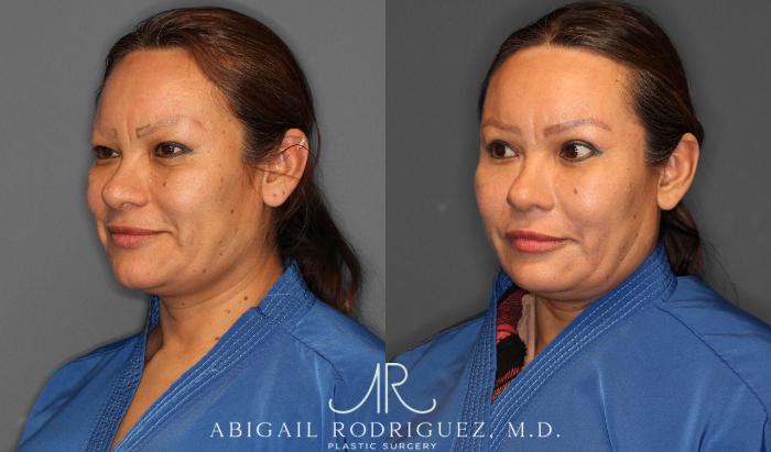 Before & After Lower Eyelid Lift Case 258632 View 2 View in Houston, TX