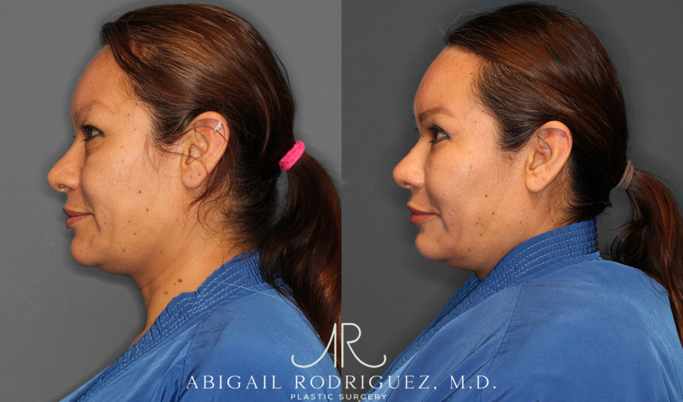 Before & After Lower Eyelid Lift Case 258632 View 3 View in Houston, TX
