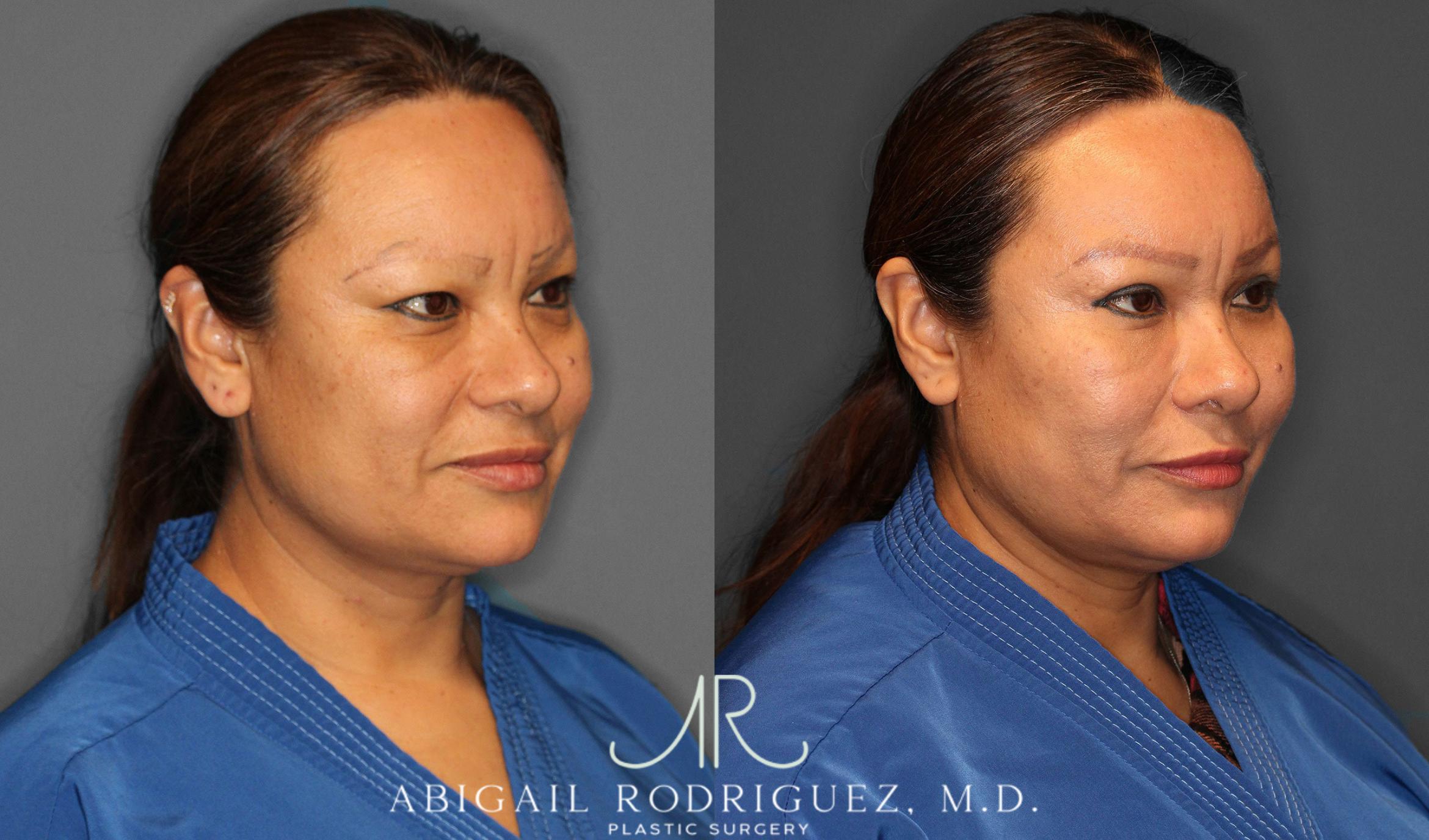 Before & After Lower Eyelid Lift Case 258632 View 4 View in Houston, TX