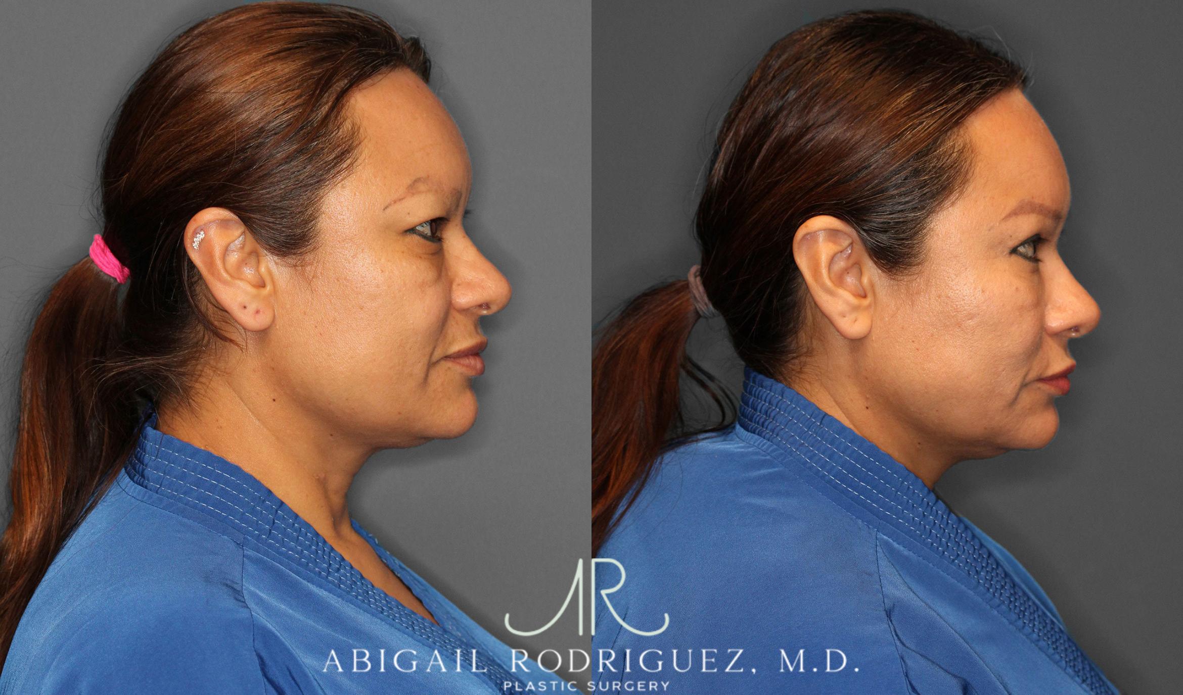 Before & After Lower Eyelid Lift Case 258632 View 5 View in Houston, TX