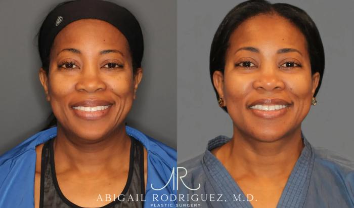 Before & After Lower Eyelid Lift Case 258990 View 2 View in Houston, TX
