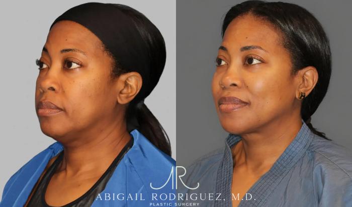 Before & After Lower Eyelid Lift Case 258990 View 5 View in Houston, TX