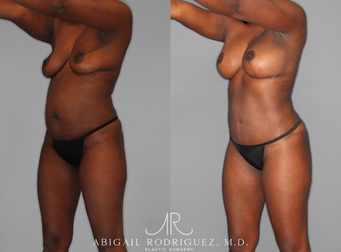 Before & After Mommy Makeover Case 253979 View 2 View in Houston, TX
