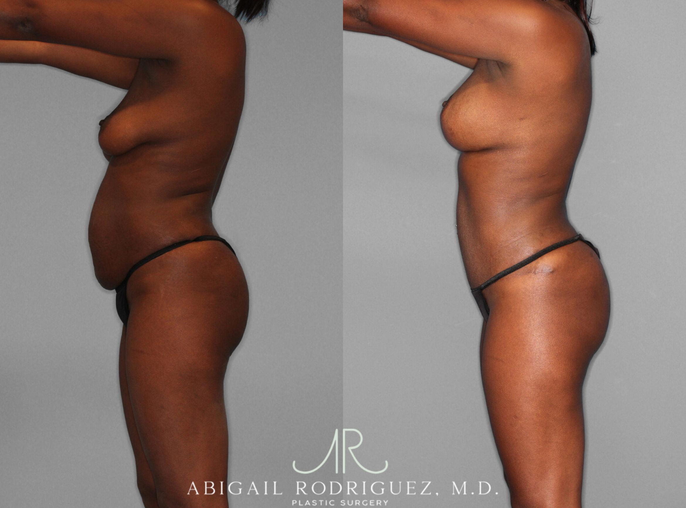 Before & After Mommy Makeover Case 253979 View 3 View in Houston, TX